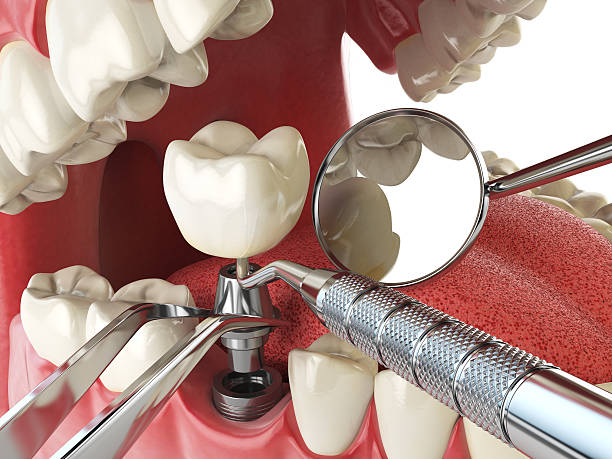 Best Emergency Dentist for Knocked-Out Tooth in Bent Creek, NC